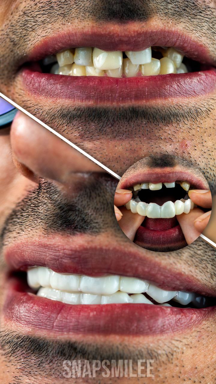  لمینت دندان دو فک اصلی برای خرابی 8 دندان vision8 دکترفروش